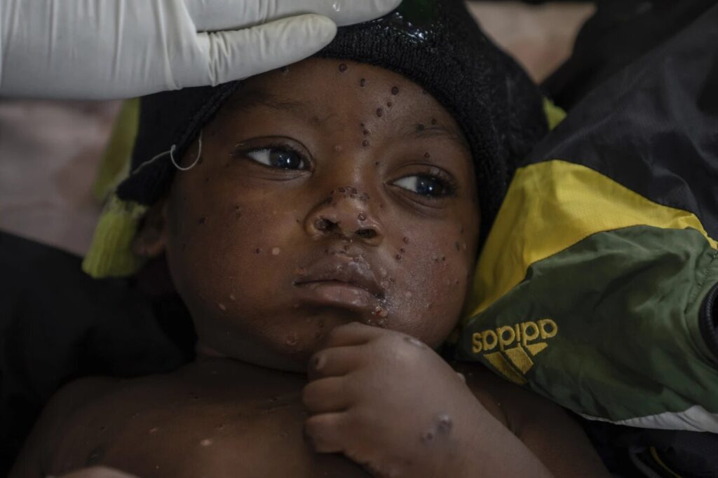 .@WHO a répertorié le vaccin #LC16m8 contre #Mpox pour une utilisation d'urgence – le 1er vaccin répertorié pour les enfants de plus d'un an en cas d'épidémie. Il s’agit d’une étape essentielle dans la protection des populations vulnérables alors que Mpox continue de se propager. pic.twitter.com/BVZrFjColN— OMS RDC (@OMSRDCONGO) November 20, 2024