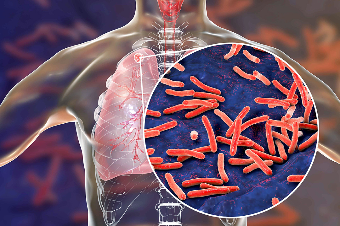 “No hay brote de tuberculosis en SEV”: Salud